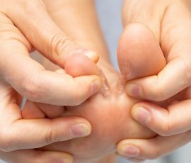 Que faire pour les mycoses des pieds ?