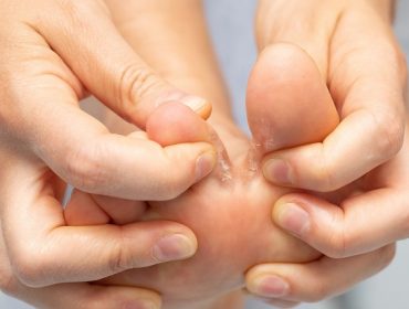 Que faire pour les mycoses des pieds ?