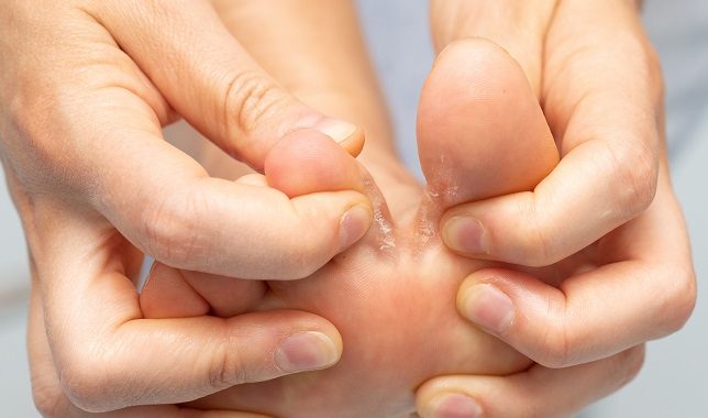 Que faire pour les mycoses des pieds ?