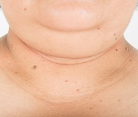 Comment maigrir des joues et du double menton ?