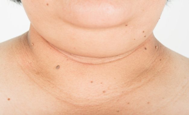 Comment maigrir des joues et du double menton ?